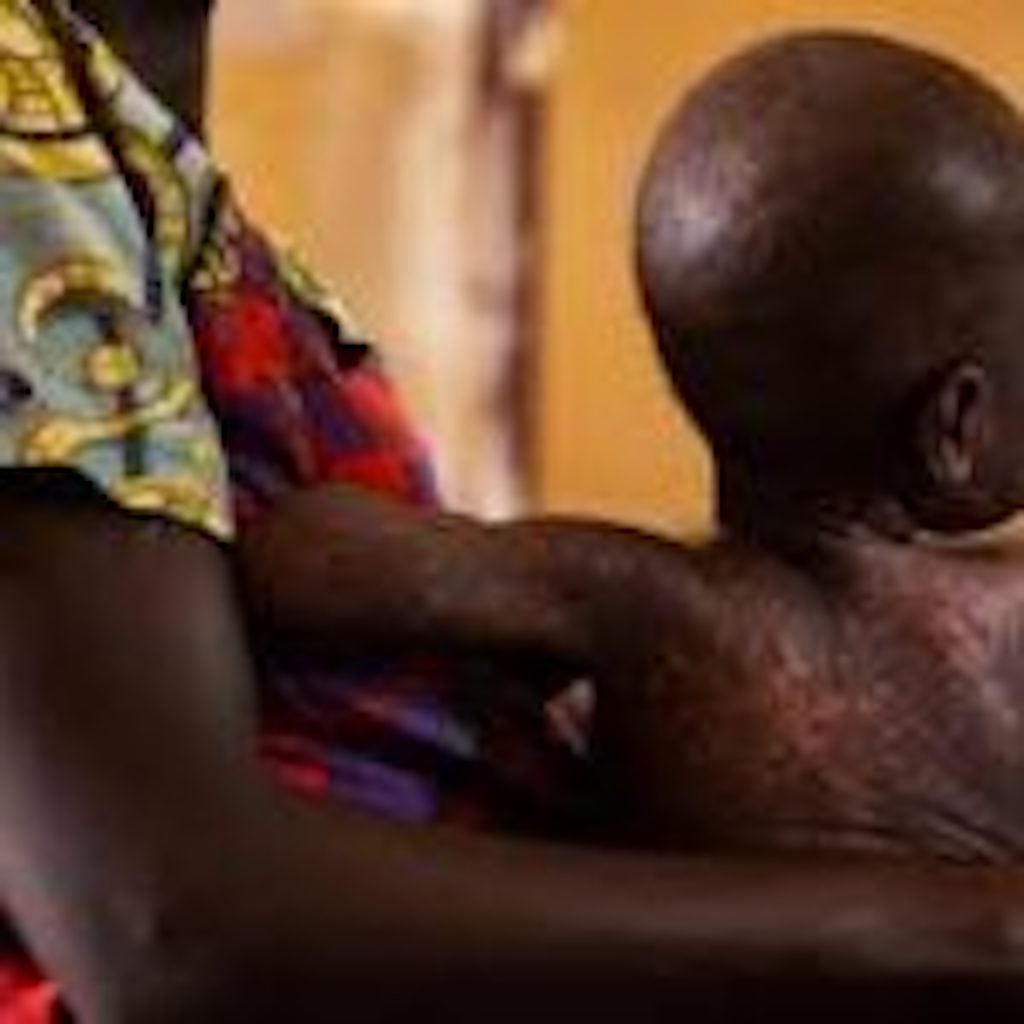 Measles death toll hits 153 in 11 months